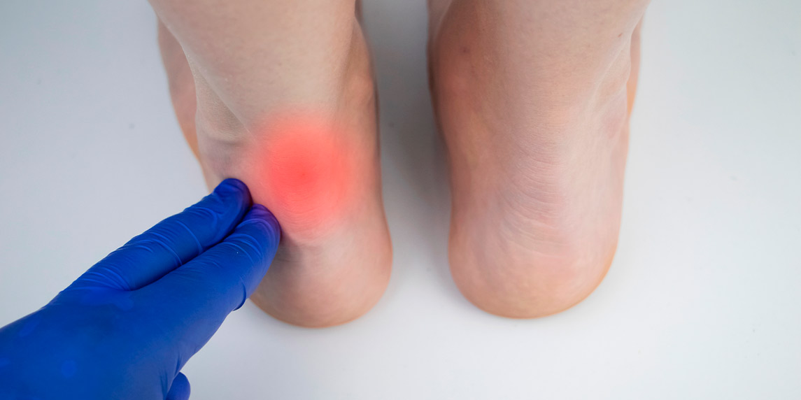 A close-up of a foot with a red mark, raising concerns about basketball shoes and their link to Achilles tears.